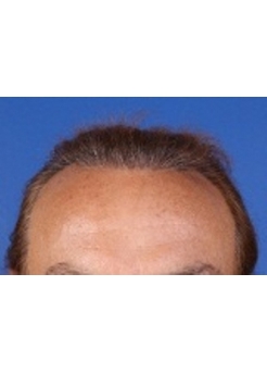 After Hair Transplant&nbsp;2 Sessions (Areas)
